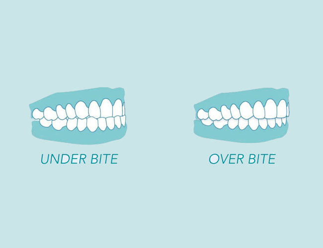 difference-between-overbite-and-underbite